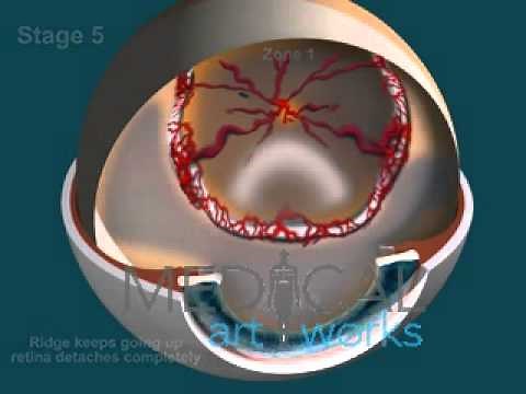 3D Medical Animation | 5 Stages ROP