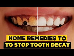 Tooth Decay Treatment: REMOVE TOOTH DECAY AT HOME With These 5 Safe Home Remedies