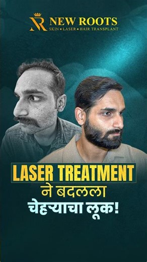 Flawless Skin Transformation! DPN Removal Using CO2 Laser | New Roots Aurangabad #shorts