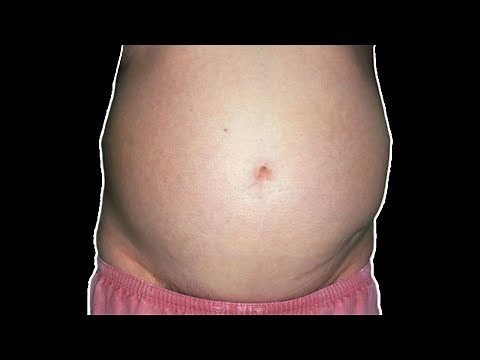 What is Ascites Fluid And How to Get Rid of Ascites In the Abdomen?