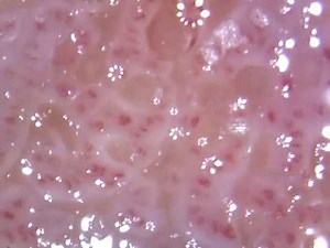 Psoriasis under microscope