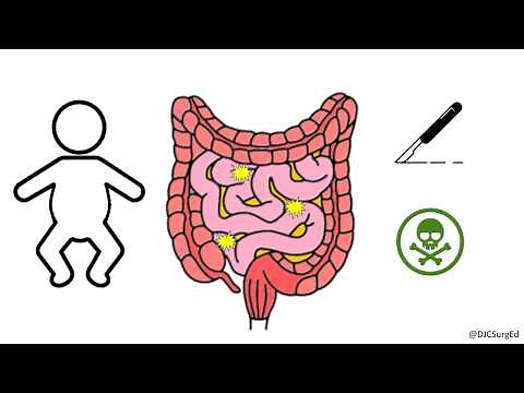 Necrotizing Enterocolitis