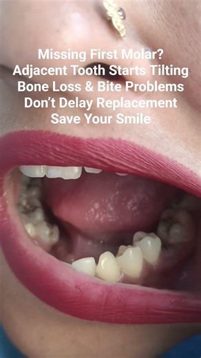 Missing Tooth for LongTime? See What Happens! Serious Consequences#dentist #TheDentalGuru#viralshort