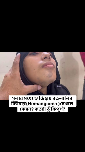 95K views · 453 reactions | গলা বা জিহ্বায় Hemangioma—কেমন দেখায়?...