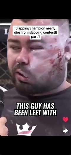 Slapping Contest Gone Wrong: Champion's Face Swollen After Brutal Match