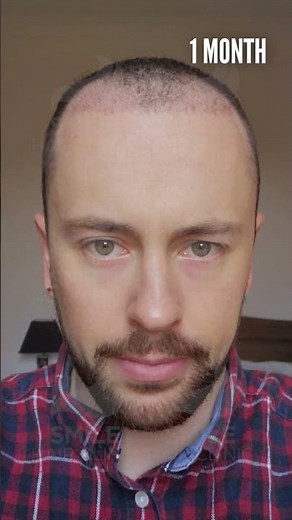 Hair Transplant Before and After of Matthew! 6 MONTHS / 5000 Grafts