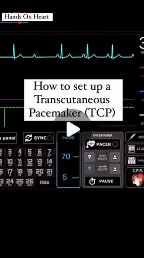 Hands On Heart 🤟🏼 | Your patient has Bradycardia and is unstable? Setting up a Transcutaneous pacemaker. Follow us @handson.heart @heartcoremt Follow us... | Instagram