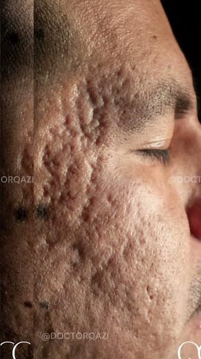 Severe Acne Scar Transformation #SkinRestoration