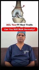 ACL Tear का Real Truth : Can You Still Walk Normally ? | Dr Neeraj Srivastava