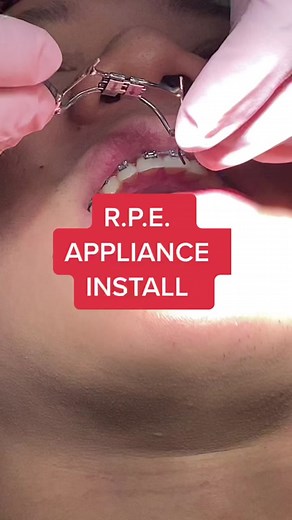 How we install an RPE! Thank you to our patient for allowing us to rec...