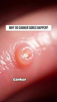 Why Do Canker Sores Hurt So Much? | RapidSmartFacts