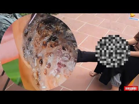 JIM RUS JIGGER REMOVAL - Extreme Jigger Nest – Crawling Under Skin! 3668