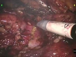 Robotic-Assisted Partial Nephrectomy • Video • MEDtube.net