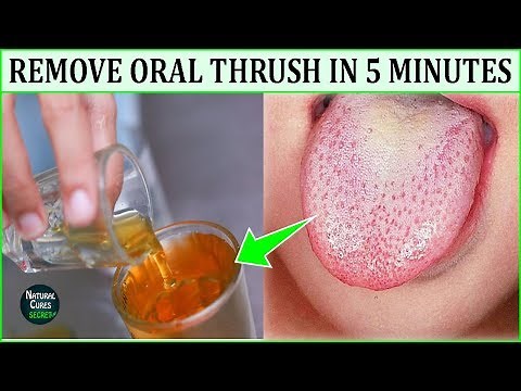 How to Get Rid of Oral Thrush Naturally In 5 Minutes - Oral Thrush Home Remedies - Dental Hygiene
