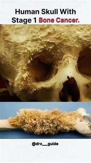 BIOLOGY• MEDICAL• HEALTH on Instagram: "Bone cancer can cause some serious changes to the human skull. When this type of cancer develops in the skull, it leads to the growth of tumors within the bone tissue. These tumors can dramatically alter the shape and structure of the skull. As the bone cancer tumors grow, they put pressure on the surrounding bones, tissues, and nerves. This can make the skull start to change shape and become deformed. You may see lumps or bumps forming on the skull, and t