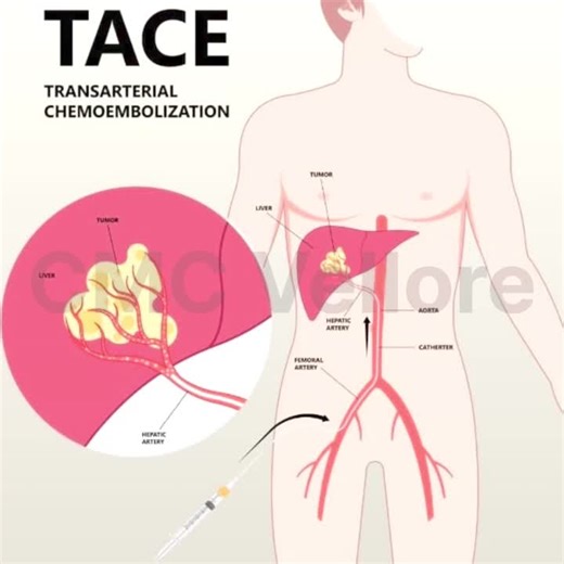 #interventionalradiology #tace #livercancer #hepatocellularcarcinoma #endovascularoncology #hepatology #multidisciplinarycare #imageguidedtherapy #minimallyinvasive #patientcentriccare #cmcvellore… | Interventional Radiology, CMC Vellore