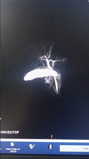 mri MRCP 3D mrcp rt HyperSense sequence, SEQUENCE