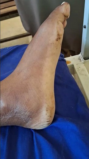 Pes planus #clinicalexamination