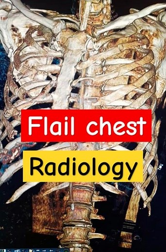 Flail chest # Radiology