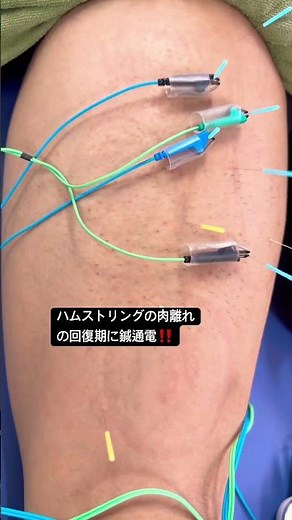 ハムストリングの肉離れに鍼通電、鍼治療