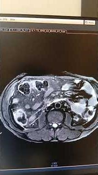 #radiology#mrcp#medicaltranscription