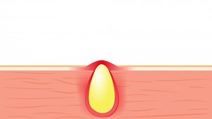 Formation Skin Acne Pimple Sebum Clogged Stock Footage Video (100% Royalty-free) 1034910896 | Shutterstock