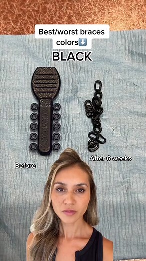 Black Braces: Before & After 6 Weeks