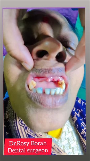 DrRosy Borah Chetia on Instagram: "Removable partial denture//nakli dant//drrosyborah//shorts//viral"