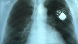 Doctor Examining X-Ray Image of Chest with Artificial Cardiac...