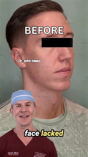 Here's how Fillers For Men can sharpen your features! #beforeandafter #fillersformen #fyp