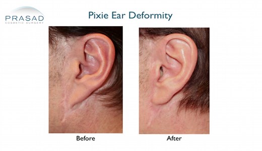 The Causes of Pixie Ear Deformity  and the Right Time for Revision