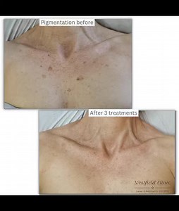 . . . . Advanced, anti-ageing Nd:YAG laser treatment with triple wavelengths. This amazing Tri-Wave laser targets: 💫 The surface of the skin to combat bacteria, oil and reduce pore size. 💫 Evens out skin tone, improving redness and inflammation. 💫 Targets pigmentation, brightens skin, improves texture, and rejuvenates. 💫 Stimulates new collagen production. If you have any questions about laser treatments drop us an email 👩‍💻 Free consultation and patch test ✍ ❔ FAQ’s on website 📞 07979017