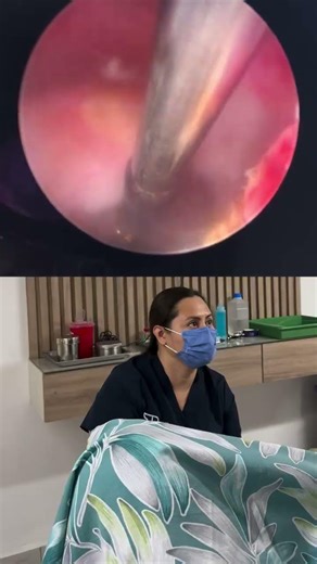 Endometrial polyps are abnormal growths in the lining of the uterus (endometrium).