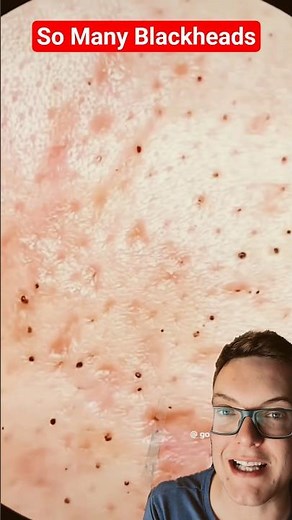Amazing BLACKHEAD REMOVAL - So Many Blackheads #shorts