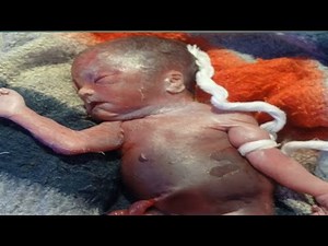 NICU Emergency: Preterm Baby Collapse & Fast Recovery After CPR & Suction l newborn care