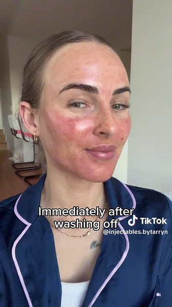 Day 3 post cosmelan 1 wash off. Heat has come down significantly, star... | TikTok