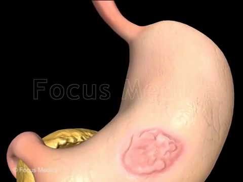 Gastrectomy - Animated Atlas of Breast and Gastric Cancer