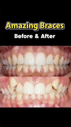 Teeth Transformation! 😱 Braces Before & After #braces