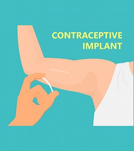 Birth Control Implant: Benefits And Side Effects