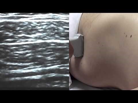Ultrasound Guided Transversus Abdominis (TAP) - SSRAUSA.com