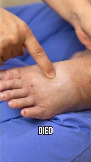 Swollen Legs | Pitting Edema is a Medical Emergency!