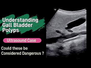 All About Gall Bladder POLYPS - Ultrasound Diagnosis | Types | Risk Factor | Treatment | Prevention