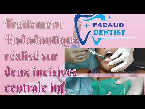 DÉVITALISATION DENTAIRE | Toutes les étapes d'un Traitement Endodontique (Dent antérieure)