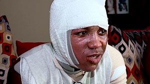 Indiana teen seriously injured by "Hot Water Challenge"