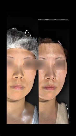 Cosmetic surgery to make nostrils less visible | Nostril rim lowering, rhinoplasty, prosthesis #r...