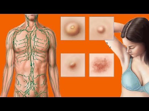 Swollen Lymph Nodes In The Armpit: Causes And Home Care