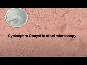 Cyclospora in Stool Microscopy