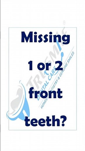 Missing a front tooth?Here’s the FIX — a Maryland Bridge 😁
