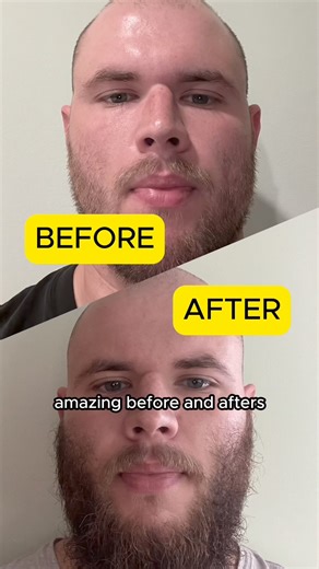 Does your beard need help? 🧔‍♂️❓ BLACK FRIDAY SALE: Save 35% Off with code FRIDAY35 | Beard Club