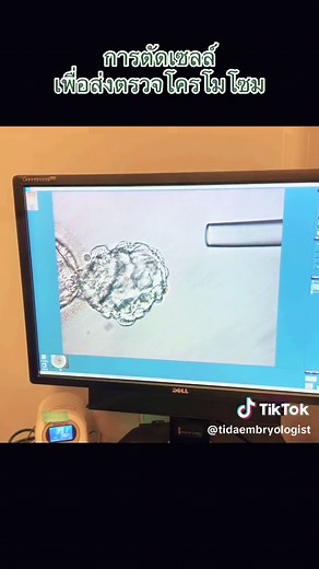 Blastocyst biopsy#flicking#laser#chromosomes #PGT #siamfertilityclinic #ivfthailand